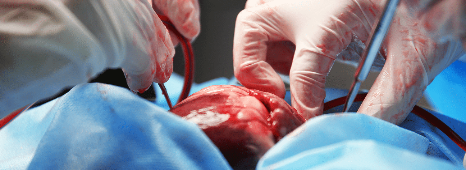 Slider-3-MemoryHit-trasplante